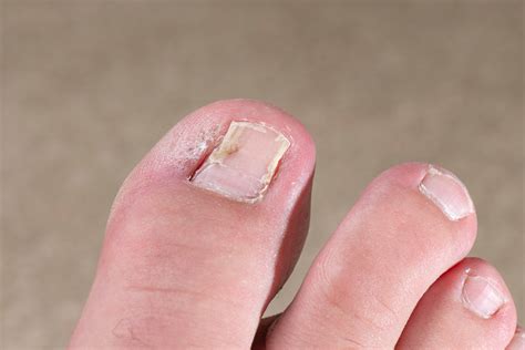 Ingrowing Toenails And How To Get Rid Of Them Permanently Lindsey