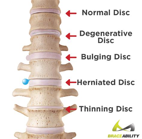 Herniated Discs And Bulging Discs What39s The Difference