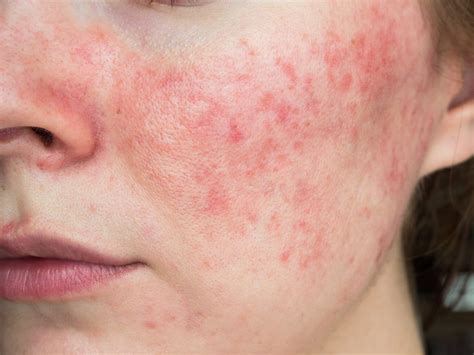 Looking Into Rosacea And Vitamin Deficiency SL Aesthetic Clinic