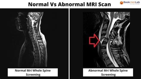 Mri Whole Spine Screening Purpose Results And Cost 2023