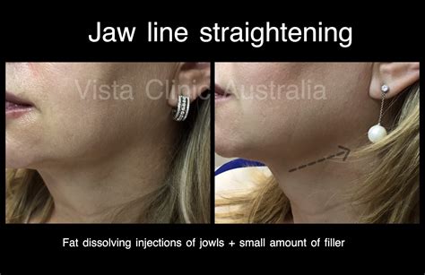 Fat Dissolving Injections Melbourne Vista Clinic
