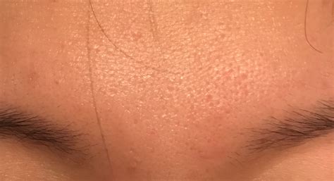 Help What Kind Of Acne Scars Do I Have Scar Treatments Forum