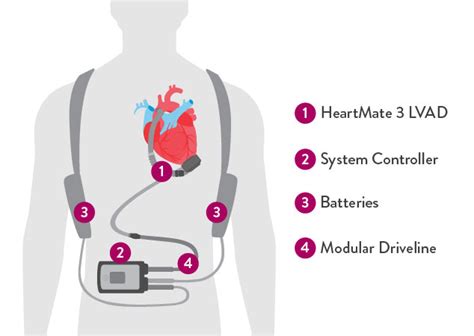 Heartmate 3 Lvad System Information Abbott