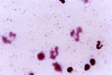 Free Picture Thick Film Blood Smear Micrograph Numerous Ring Form Plasmodium Falciparum