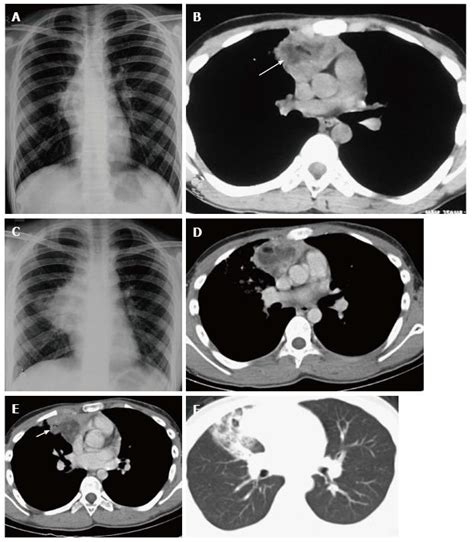 Imaging Of The Pediatric Thymus Clinicoradiologic Approach