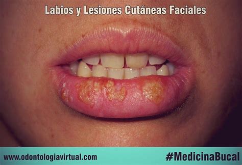 Lesiones Labios Odontología Labios Dental Y Odontología