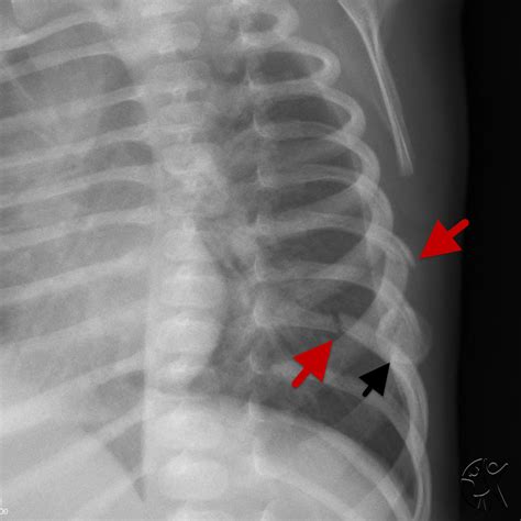 Oblique X Ray Of Acute And Healing Rib Fractures