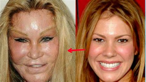 Worst Before After Plastic Surgery