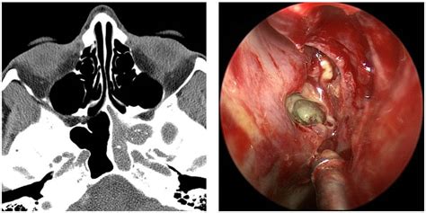 Fungal sinusitis is a broad term used to describe various situations when fungus might be involved in the cause or symptoms of nasal and sinus inflammation. Learn about Fungal Sinusitis