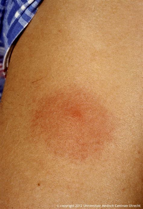Bullseye Rash Erythema Migrans Wikipedia You Need To Go To Out Of My