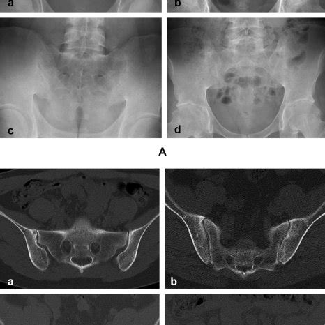 Grading Of The SI Joint In AS Patients Is Shown On The AP View Of The Download Scientific