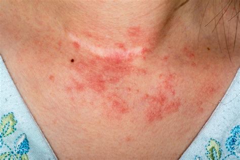 Mild Eczema On Back