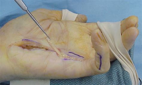 Reconstruction: Small finger flexor tendon rupture within the carpal tunnel