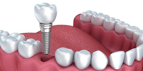 Easton Dental Implants Replace Missing Teeth Restorations