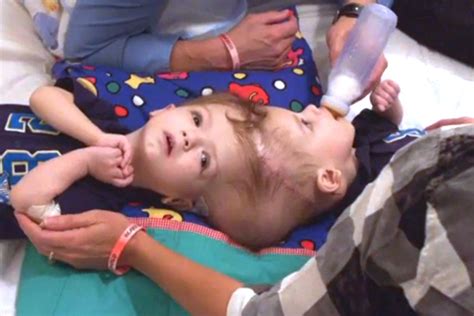 Conjoined Twin Boys Separated In Rare Surgery