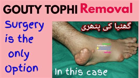 Gout Surgery Of Foot Ii Ghatiya Kee Pathree Ii Large Gouty Tophi