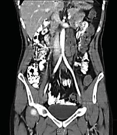 Abdominal Ct Scan Showing A Retroperitoneal Mass On The Left Side Of