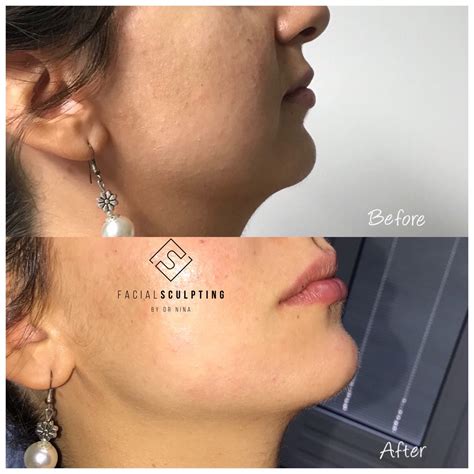 Injectable Fillers A Simple Way To Enhance Your Jawline Justinboey