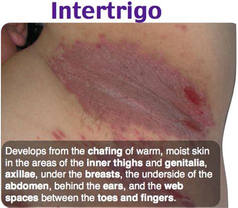 Intertrigo Factori De Risc Cauze Simptome I Tratament My Xxx Hot Girl