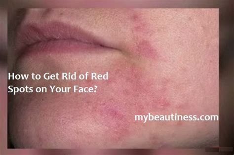 How To Get Rid Of Red Spots On Face Contents What
