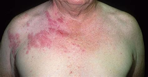 What Does Shingles Look Like Findatopdoc