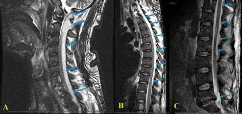 Cureus The Surgical Management Of Holospinal Epidural Abscess A Case