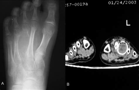 A Case Of An Aneurysmal Bone Cyst Of A Metatarsal Review Of The