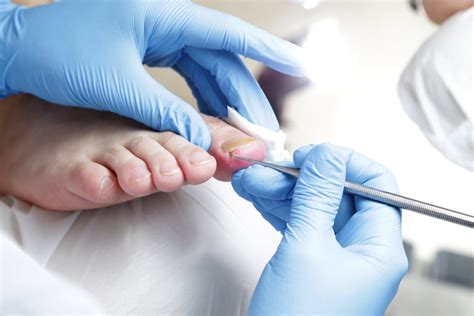 Caring For Your Ingrown Toenails After Nail Surgery Perform Podiatry