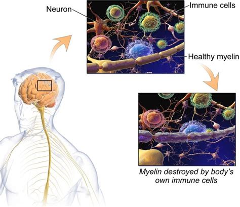 Knowing What Causes Ms Brings Us Closer To A Solution