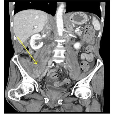 A Contrast Enhanced Axial Ct Image Through Upper Pelvis Demonstrate