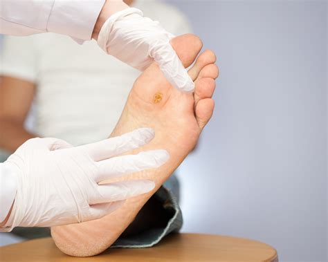 Foot Wart Removal Surgery Bruin Blog