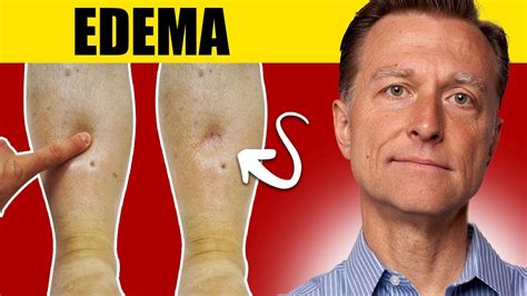 8 Surprising Causes Of Edema Uncover The Truth Youtube