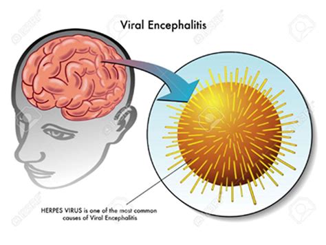 Encephalitis Types Symptoms Causes Risk Factors Diagnosis