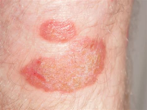 Psoriasis Types Causes Symptoms Risk Factors Diagnosis And