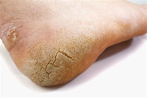 Dry And Rough Skin On Foot Cracked Heel Isolated On White Background