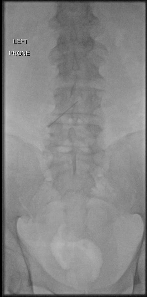 Fluoroscopic Guided Lumbar Puncture Image