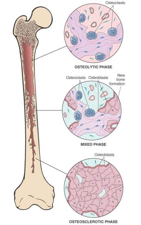 Pagets Disease Medchrome