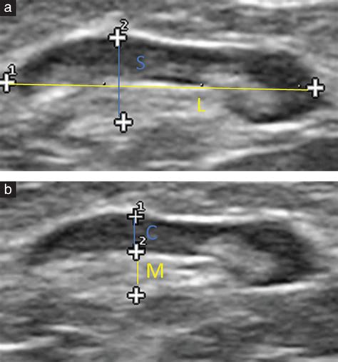 Ultrasound Morphometric And Cytologic Preoperative Assessment Of