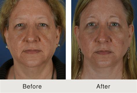 Carolina Facial Plastics Understanding The Effects Of Skin Aging
