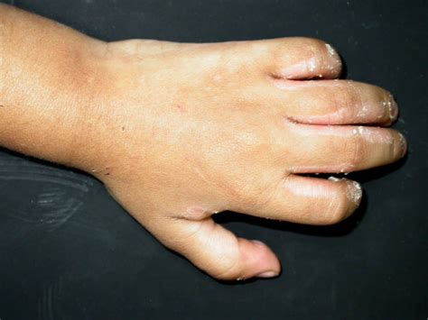 Symmetrical Interdigital Hyperkeratosis Of The Hands A Case Report