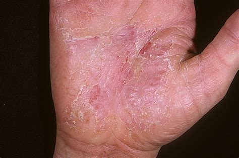 Dry Eczema On Hands Pictures Photos Images Illnessee Com
