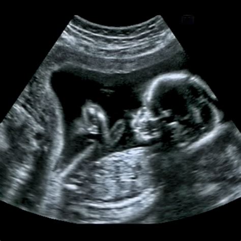 Baby Bound Ultrasound 3d And 4d Ultrasounds In Chicago