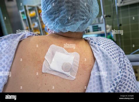 Un Paciente Tiene Un Absceso Grande En La Espalda Fotografía De Stock