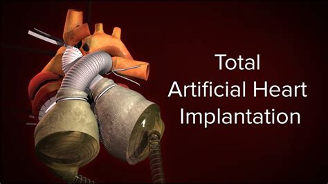 Medical Animation Total Artificial Heart Implantation Cincinnati