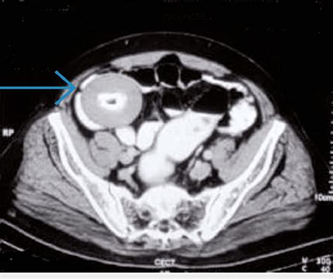 Axial Contrast Enhanced Ct Cect Scan Of The Abdomen With Iv And Oral