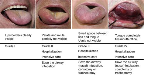 The Angiotensin Converting Enzyme Induced Angioedema Immunology And