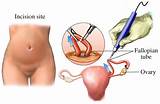 Tubal Ligation Covered By Insurance