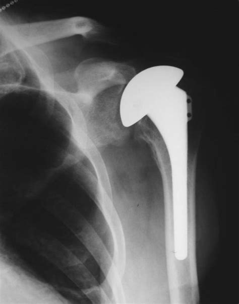 Chronic Glenohumeral Dislocation Anterior And Posterior Cancer