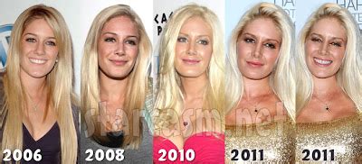Heidi Montag Plastic Surgery Before And After Breast Implants And Facelift Celebrity Before