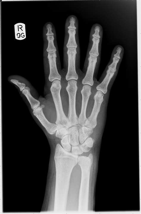 Hand X Ray Causes Symptoms Treatment Hand X Ray